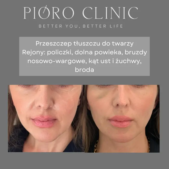 Przeszczep tłuszczu - lipofilling Kielce