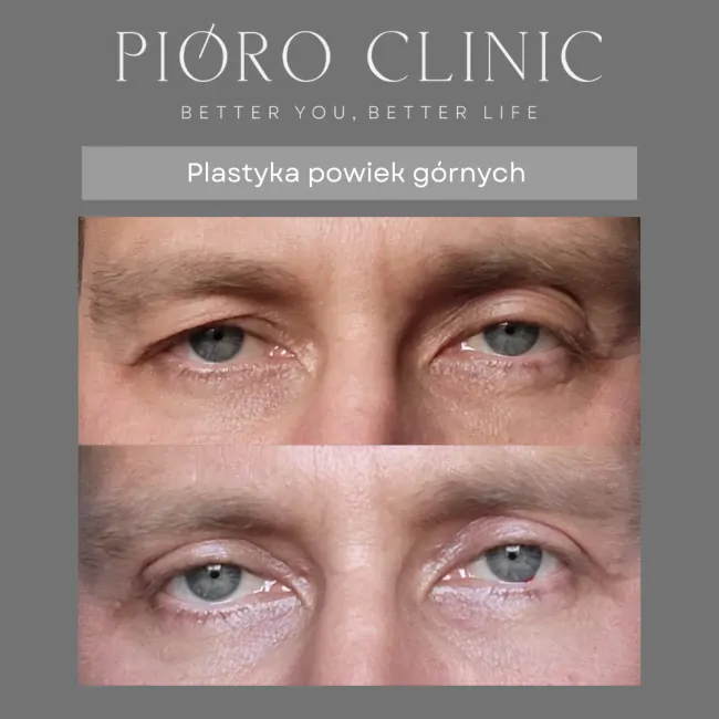 Plastyka powiek Kielce - Blefaroplastyka