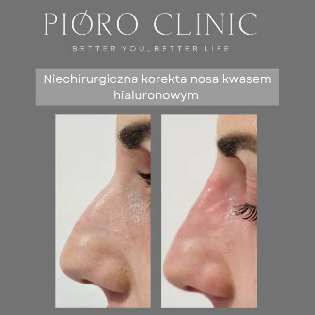 Niechirurgiczna korekcja nosa Kielce