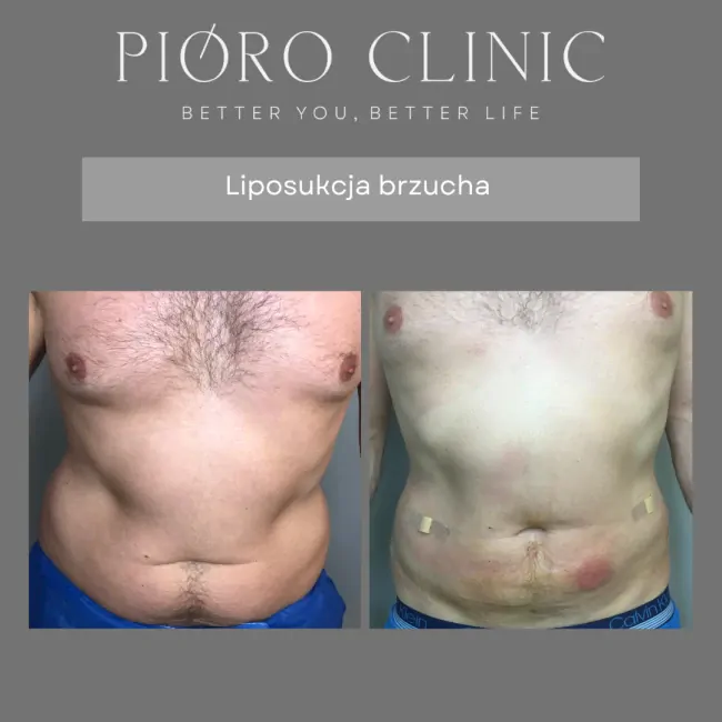 Liposukcja NIL  w Kielcach