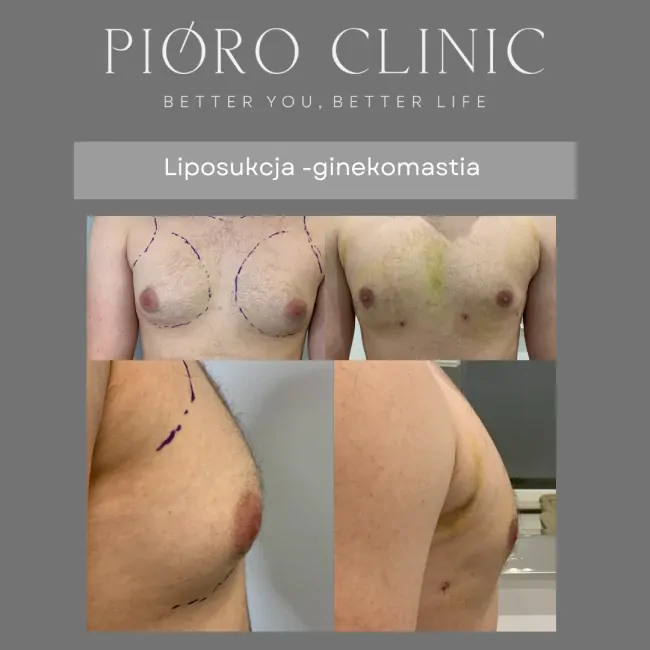 Ginekomastia tłuszczowa - liposukcja Kielce