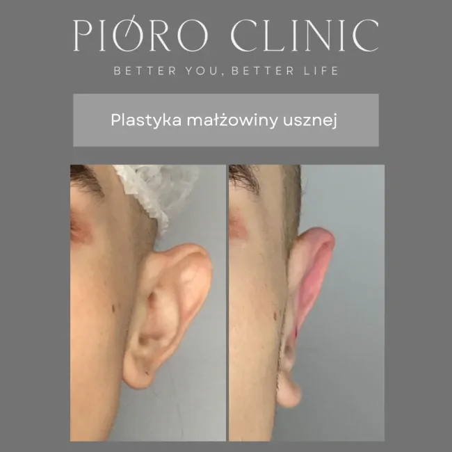 Plastyka uszu Kielce