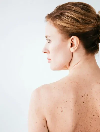 Wycinanie zmian skórnych, kaszaków, włókniaków