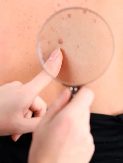 Konsultacja dermatologiczna