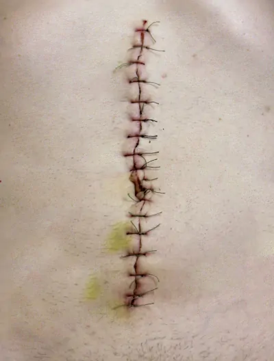 Chirurgiczne opracowanie rany