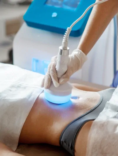 Laserowe leczenie blizny po cesarskim cięciu