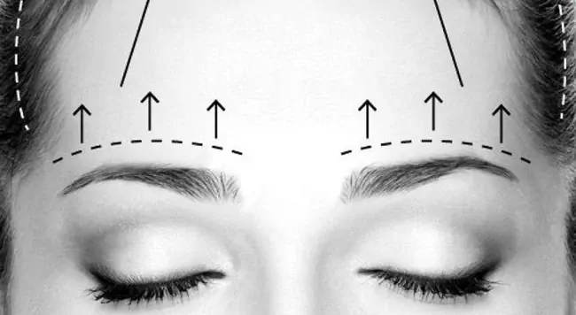 Endoskopowy lifting brwi Kielce