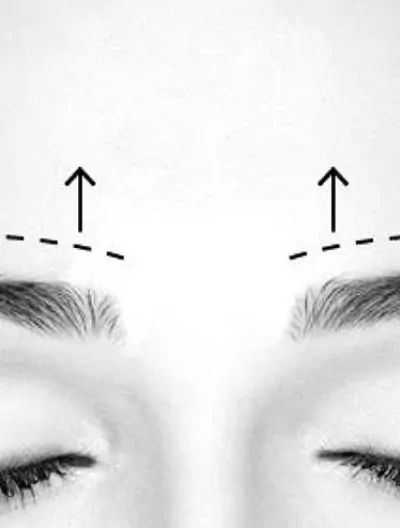 Endoskopowy lifting brwi