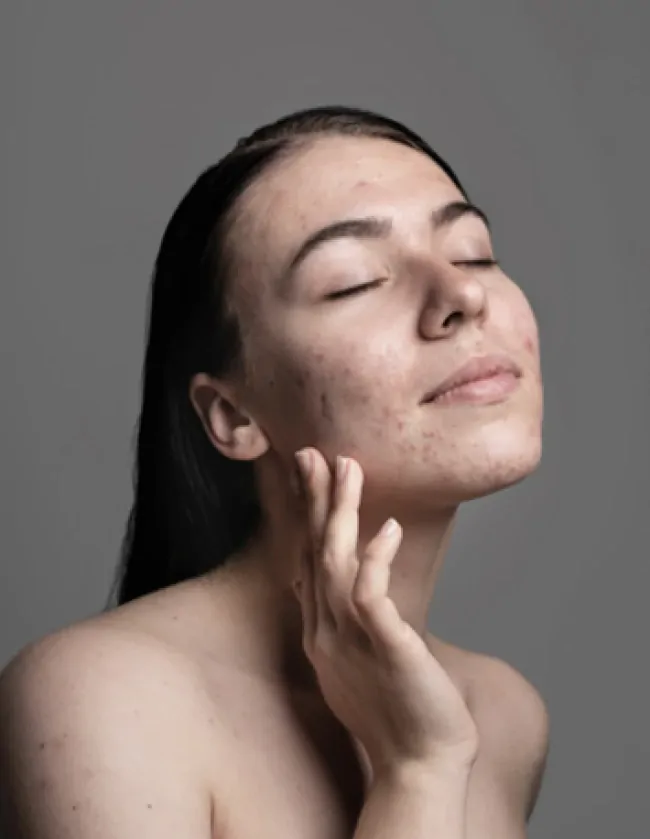 blizny potrądzikowe